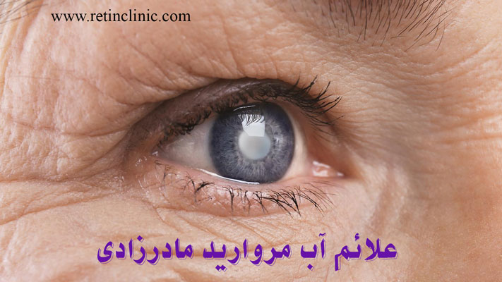 علائم آب مروارید مادرزادی