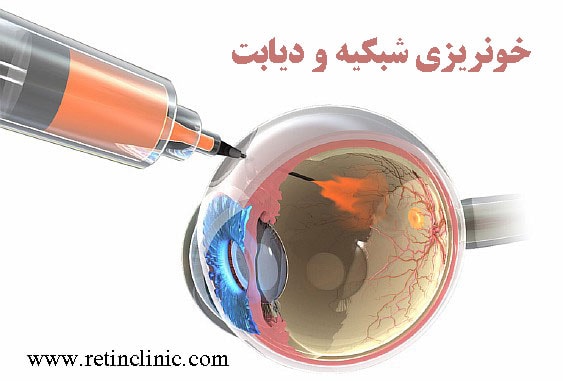 خونریزی شبکیه و درمان