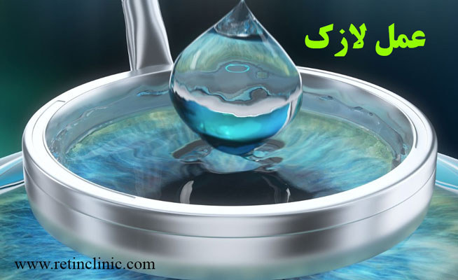 عمل لازک