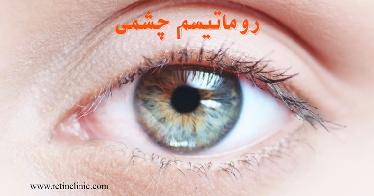بیماری روماتیسم چشمی