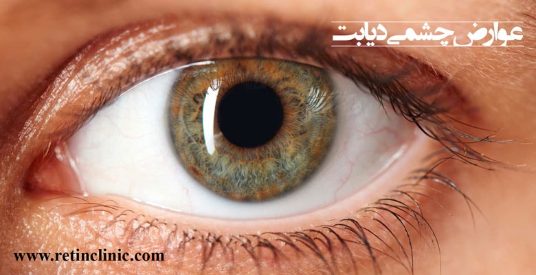 عوارض چشمی دیابت