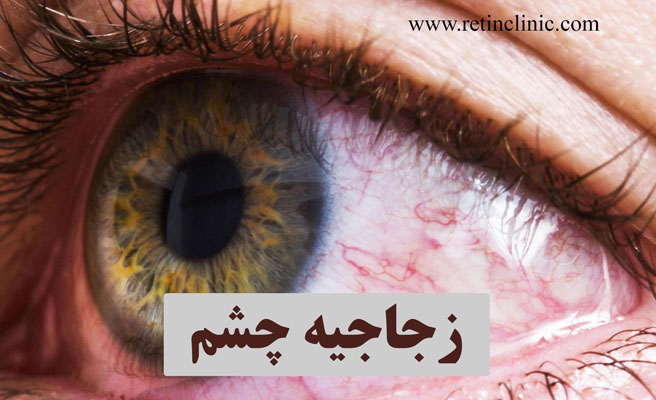 زجاجیه چشم
