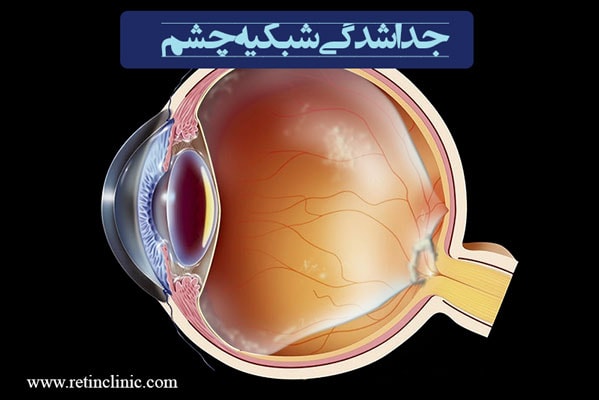 جداشدگی شبکیه چشم