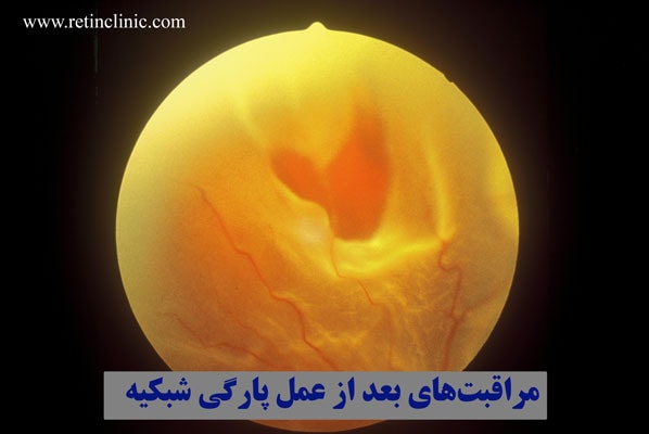 مراقبت‌های بعد از عمل پارگی شبکیه