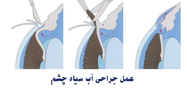 عمل جراحی آب سیاه چشم