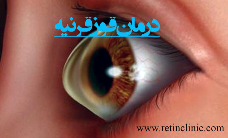 درمان قوز قرنیه