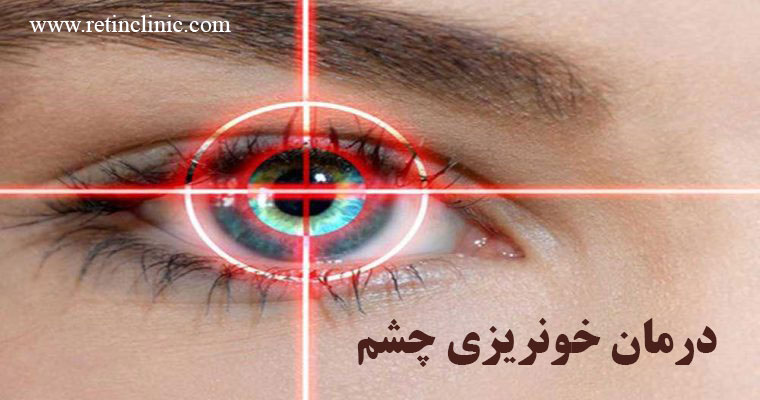 درمان خونریزی زجاجیه