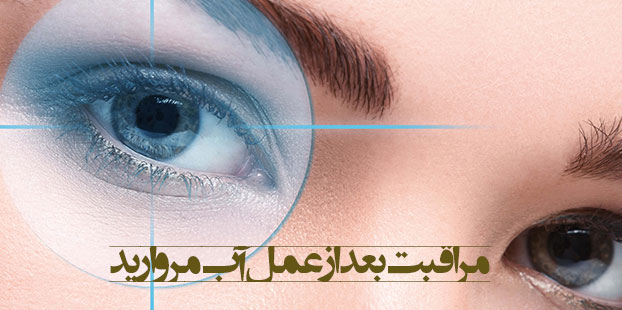 مراقبت بعد از عمل آب مروارید
