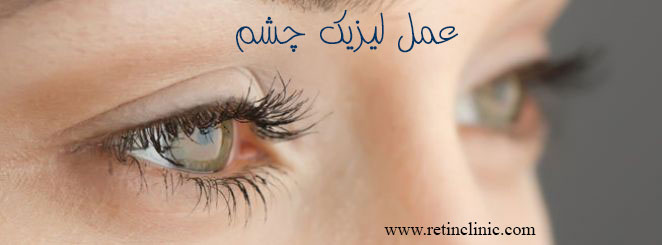 عمل لیزیک چشم