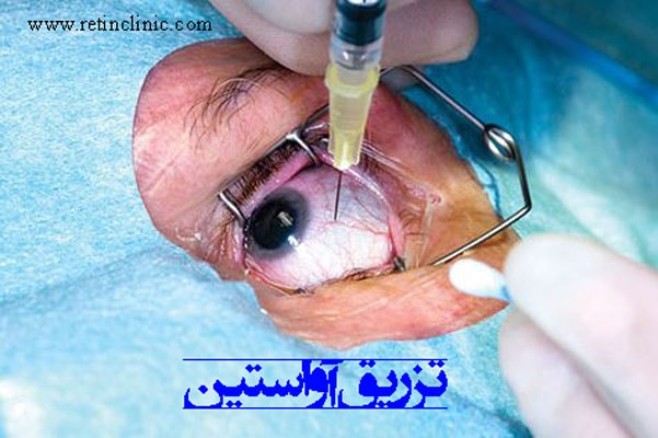 تزریق آواستین