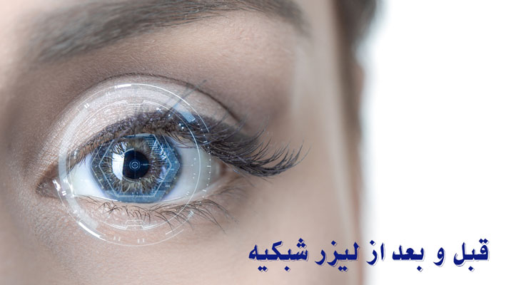 کات مهم در قبل و بعد از لیزر شبکیه