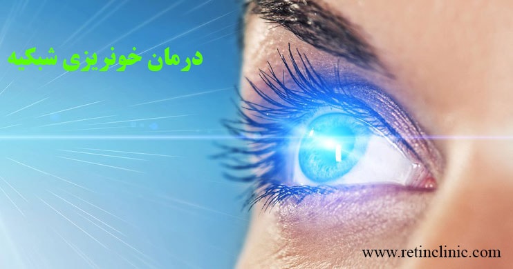 درمان خونریزی شبکیه چشم