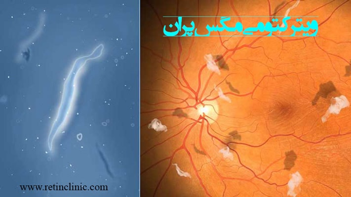 ویترکتومی مگس پران