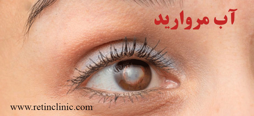 بیماری های چشمی دیابت - آب مروارید